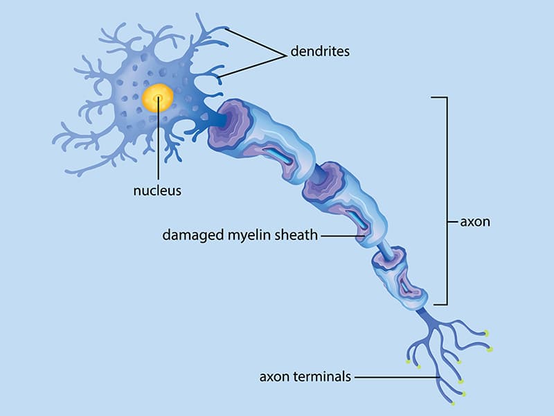 Multiple Sclerosis (MS)